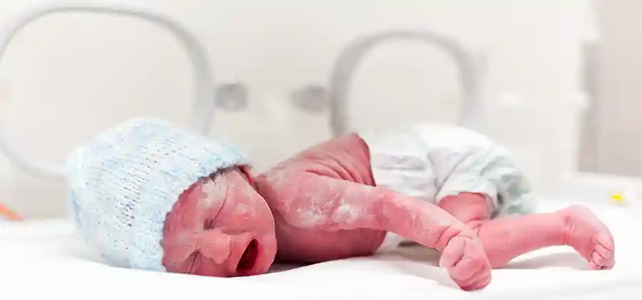 Infant with brachial plexus birth injury showing limited arm movement from nerve damage during delivery