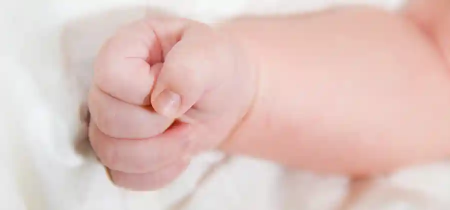 Infant showing signs of Erb's palsy with limited arm movement following brachial plexus birth injury